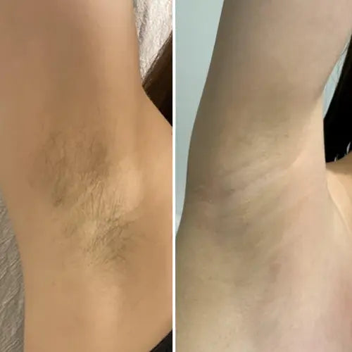 before | after — underarms