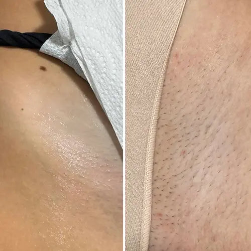 before | after — bikini line